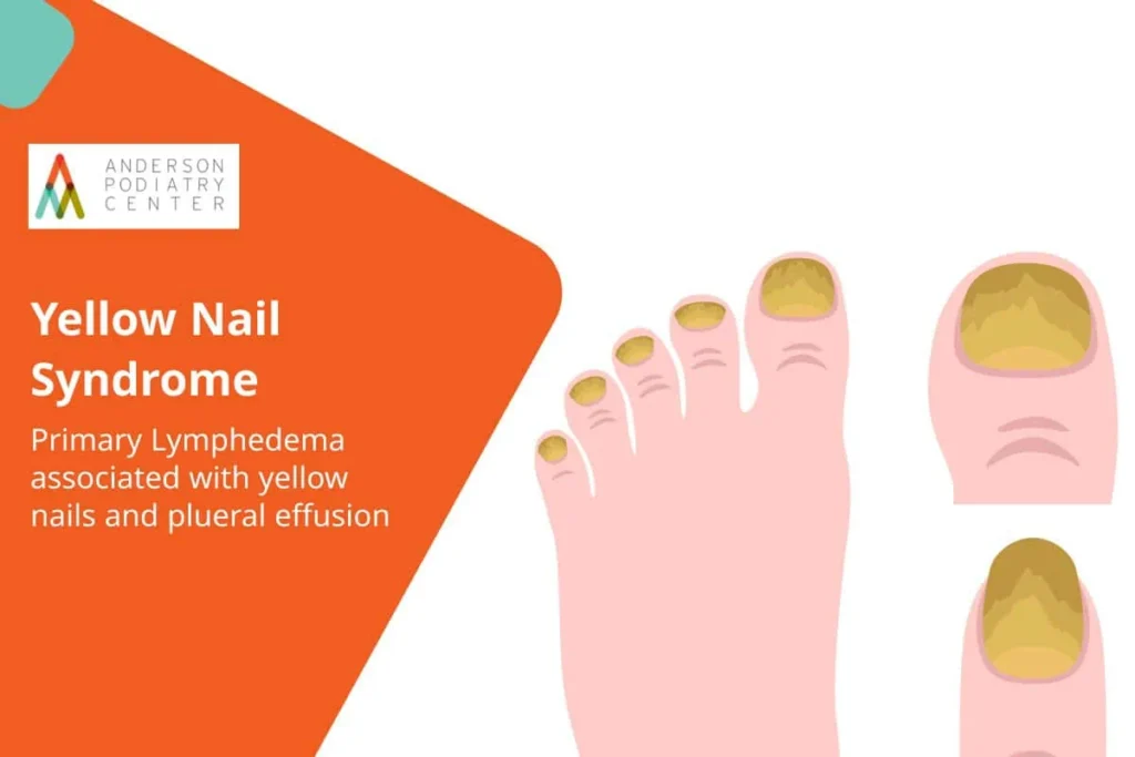 Thick Yellow Toenails Infographic Causes