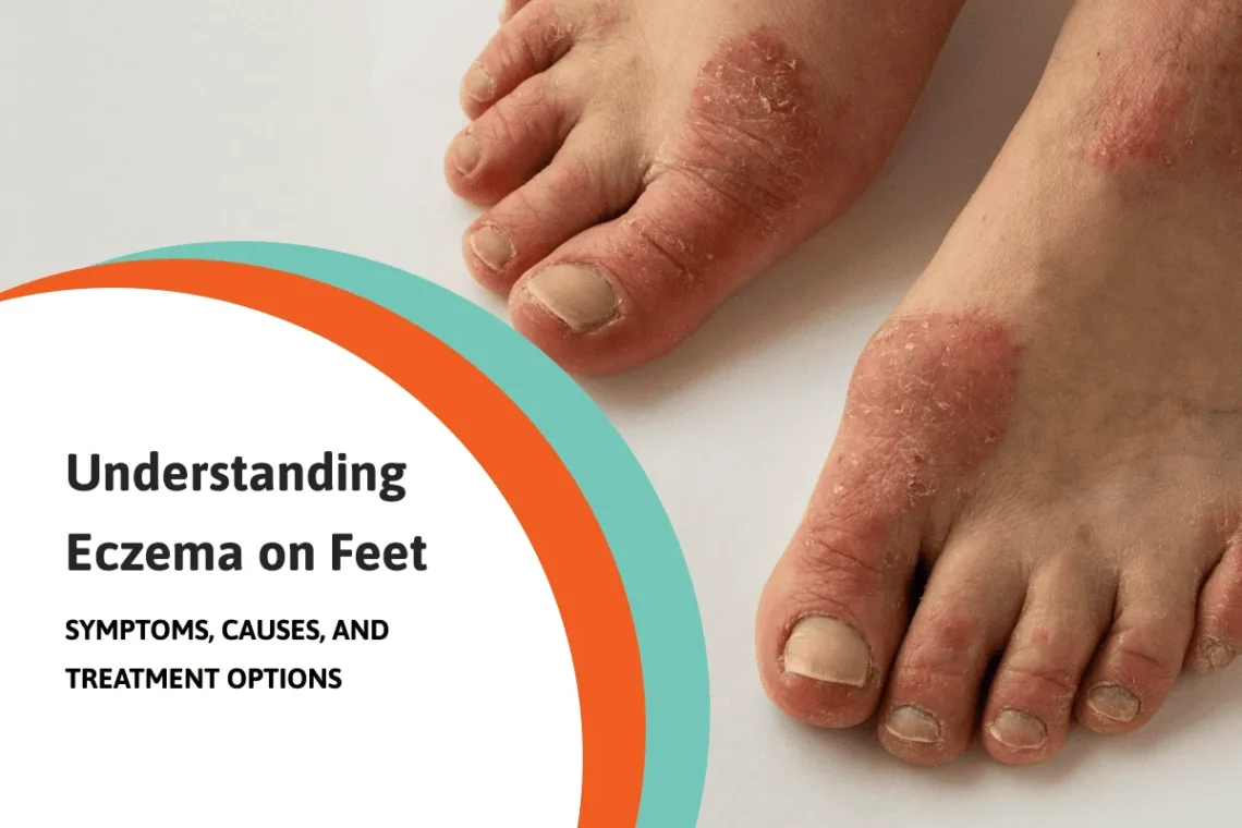eczema on feet