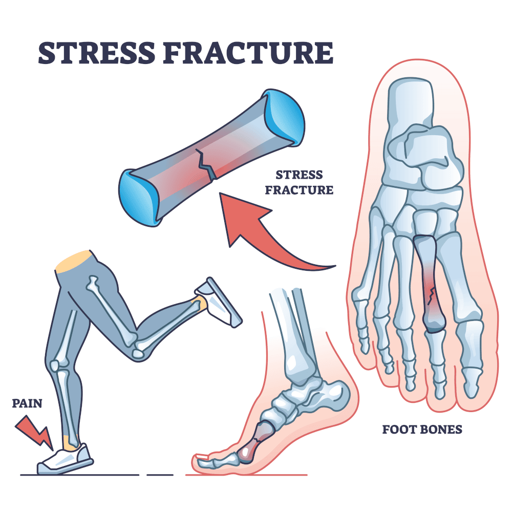 Stress Fracture on Top Of Foot - Infographic - Overuse